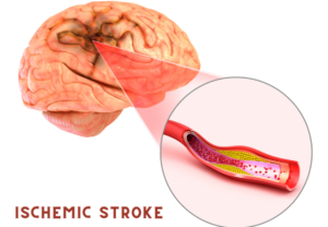 Ischemic Stroke and Hemiplegia